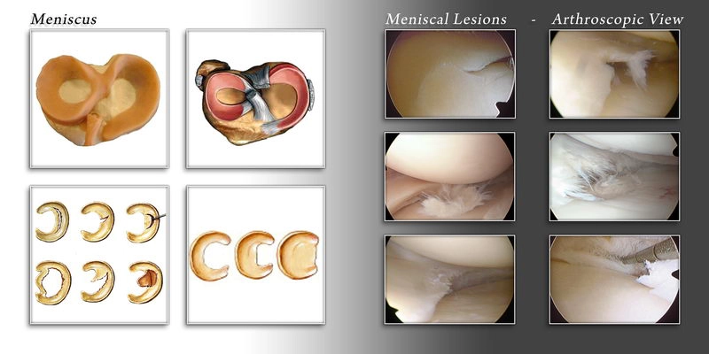 Menuscal Lesions meniscal tear