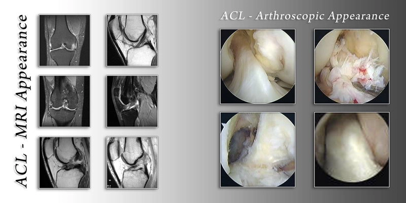 Ligament Damage Examples ligament