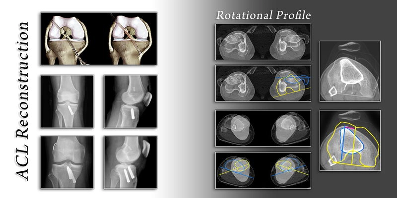 Ligament Reconstruction Examples ligament reconstruction